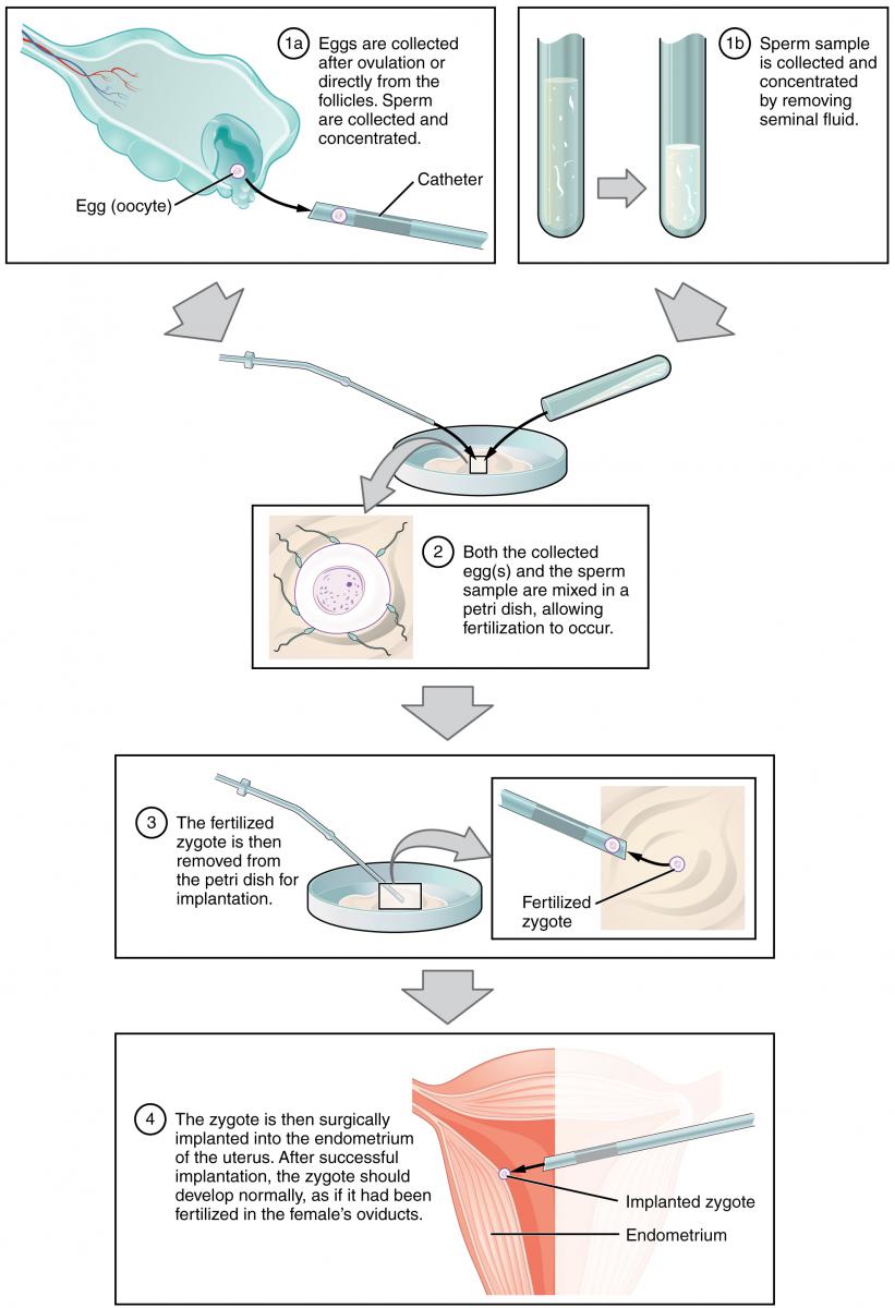 A diagram of the process of in vitro fertilization.