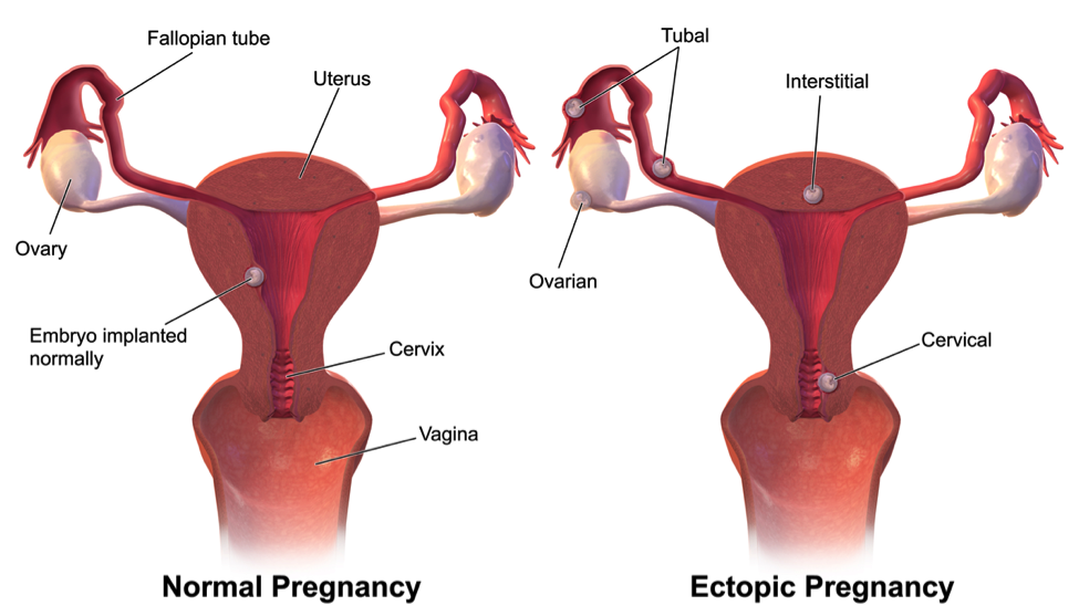Two disgrams of the female reproductive system. One diagram is of a normal pregnancy and one is for an ectopic pregnancy. 