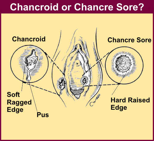 Vulva diagram displaying differences between chancroid and chancre sore