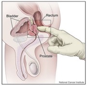 Anatomical diagram with a finger is inserted into the anus. The diagram includes bladder, rectum, and prostate.