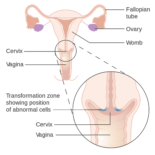 A cartoon diagram of reproductive anatomy. From top to bottom, it is labeled: fallopian tube, ovary, womb, cervix, transformation zone showing position of abnormal cells, cervix, vagina.