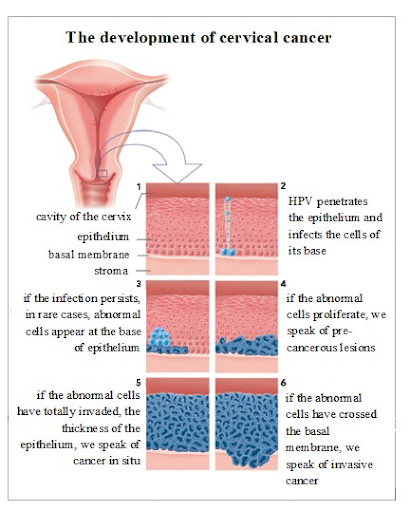 A diagram titled "The development of cervical cancer." Below, there is a cartoon image of a uterus and 6 images detailing the steps between HPV infection and abnormal cell growth.  