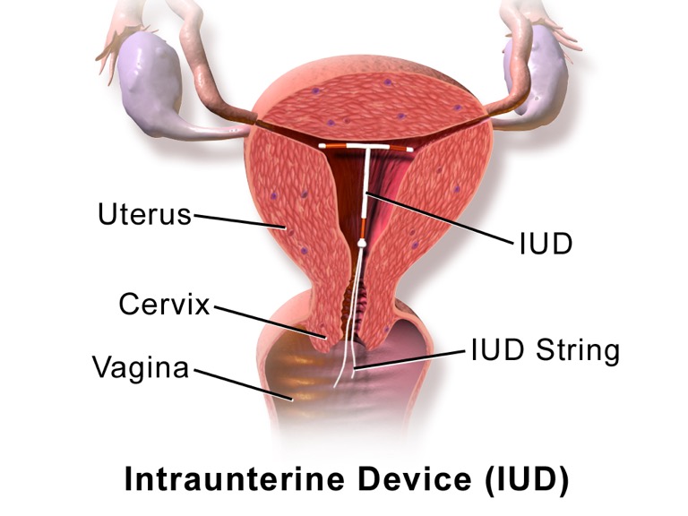 IUD Diagram