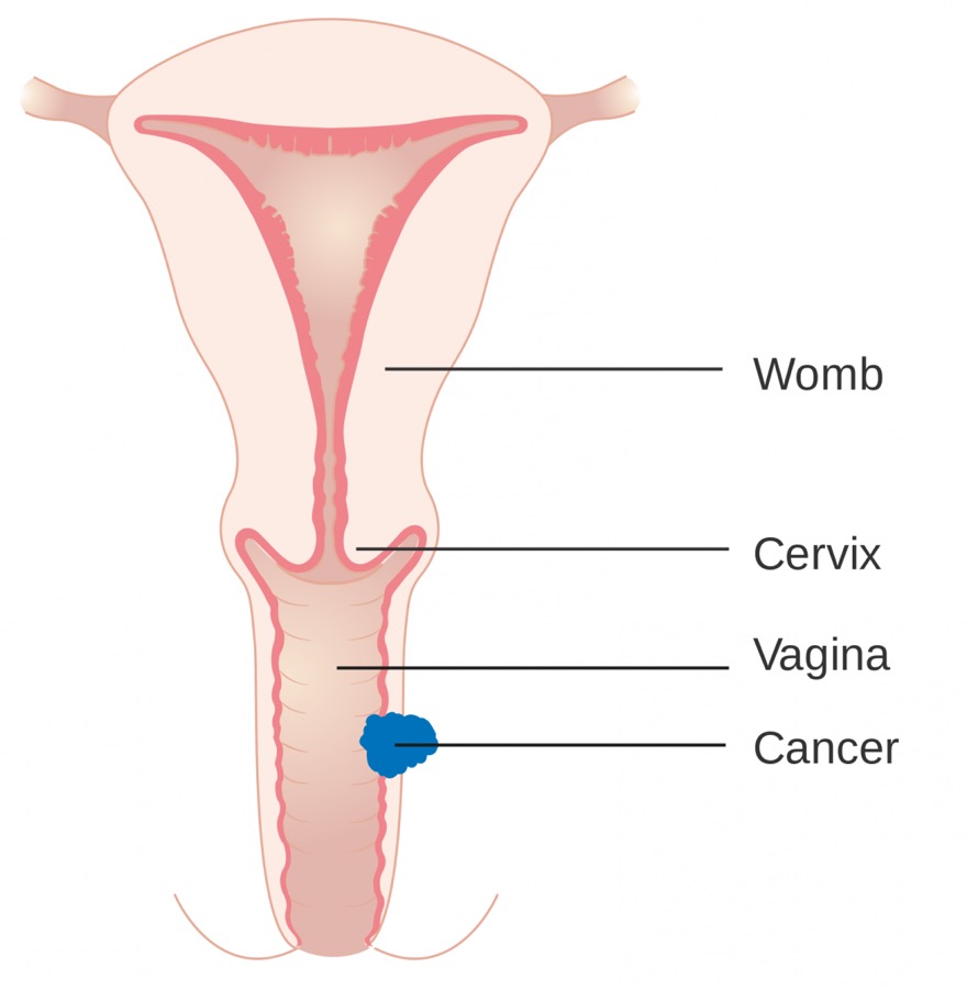Vaginal Cancer Diagram