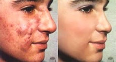 Before and after of woman's face, one of her acne and one where acne cleared up