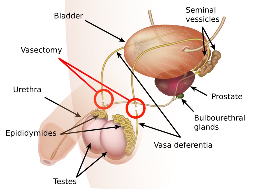 Diagram of the male reproductive system including: seminal vesicles, prostate, bulbourethral glands, vasa deferent, testes, epididymides, urethra, and bladder. The diagram labels a vasectomy.