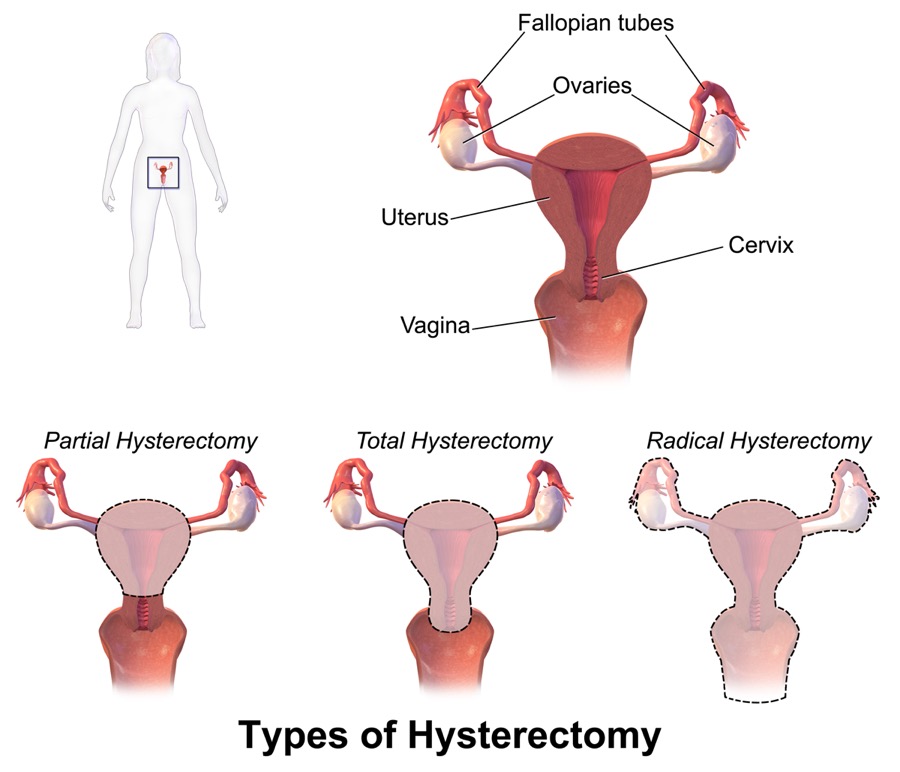 Graphic of a uterus, with the fallopian tubes, ovaries, uterus, cervix, and the vagina labelled. Below that, three graphics of uterus in a partial hysterectomy, total hysterotomy, and radical hysterectomy