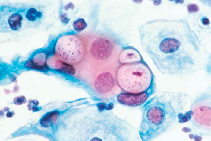 Magnified depiction of chlamydia