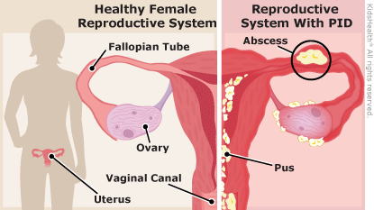 Anatomical diagram with "Healthy Female Reproductive System" including the uterus, Fallopian tube, ovary, and vaginal canal. The right side of the diagram includes the "Reproductive System with PID" with an abscess and pus.