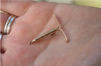 A copper IUD. 