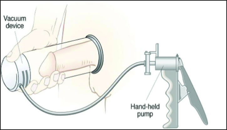 A vacuum constriction device (penis pump). 