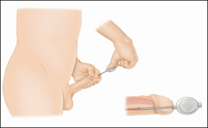 A pellet being inserted through the urethral opening of the penis. 