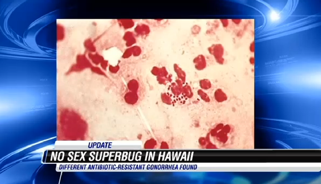 News report of super gonorrhea. The newsline reads, "No sex superbug in Hawaii. Different antibiotic-resistant gonorrhea found."