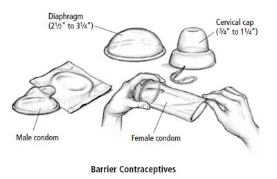 Assortment of barrier contraceptives, including male condom, diaphragm, female condom, and cervical cap. 