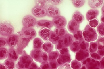 A microscopic view of gonorrhea. 