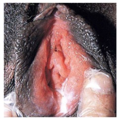 A vagina with white fluid. 
