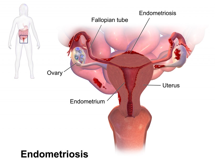 An anatomical diagram of endometriosis.