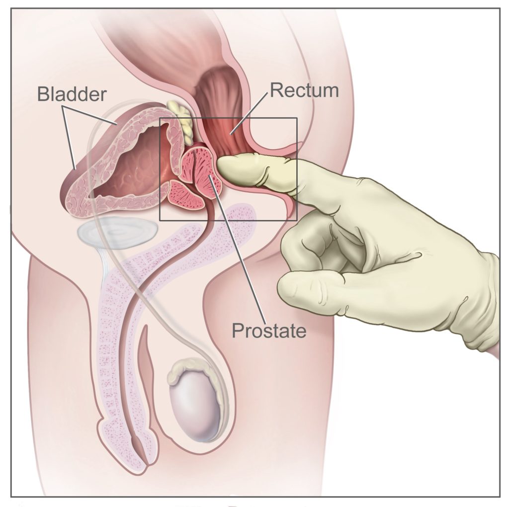 A finger inside the rectum and touching over the prostate.