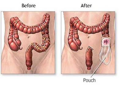 before and after of colon cancer treatment