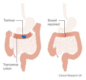 Tumor on left, rejoined bowel on right