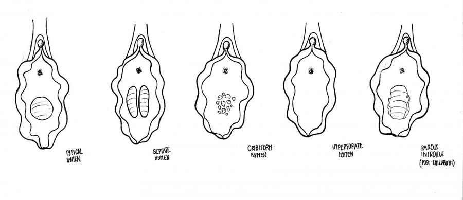 Five drawn hymen types. One hymen is the typical hymen, one is the septet hymen, one is the cribriform hymen, one is the imperforate hymen, and the parous Introits hymen.