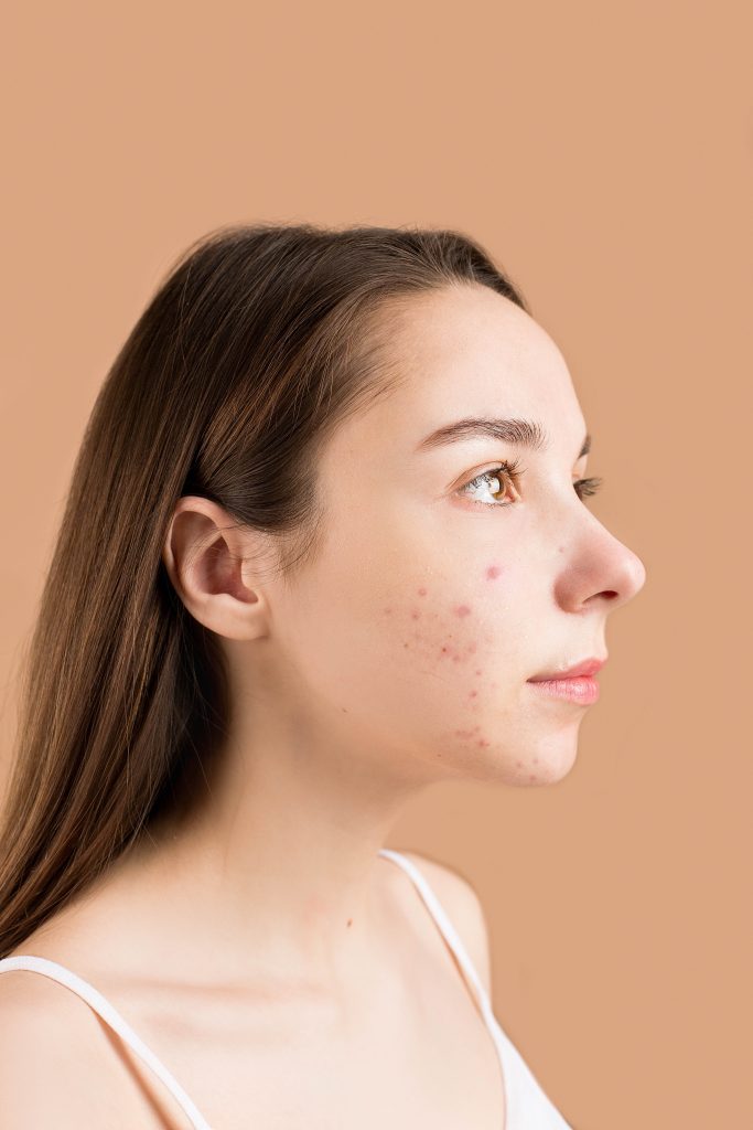 A person's side-profile. The person's cheek has visible acne.