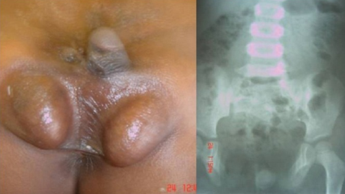 Young male with two penises and an x-ray demonstrating a mass in the pelvic cavity.