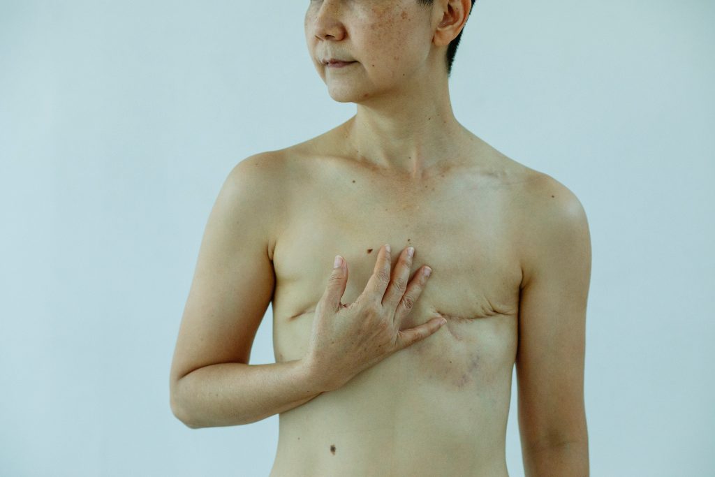 A person with mastectomy scars is touching their chest.