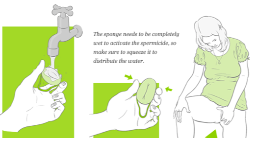 Step-by-step diagram depicting someone wetting the sponge, squeezing it and inserting it into the vagina.