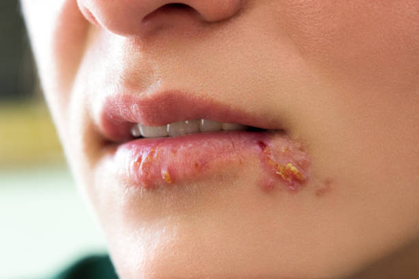  a person's lower face. Their lips have multiple red and pink blisters, showing they are dealing with Cold Sores.