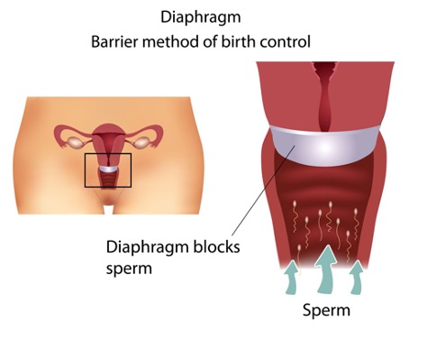 Diaphragm: Barrier method of birth control. A diagram showing the placement of a diaphragm inside of the vagina. The diaphragm is blocking  sperm from reaching the cervix.