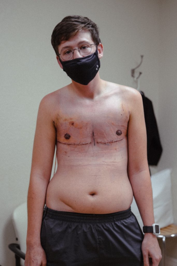 A person wearing a face mask, glasses, and no shirt with scars from recent breast reduction surgery